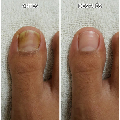 NailFix · Tratamiento Anti-Hongos 7 Días
